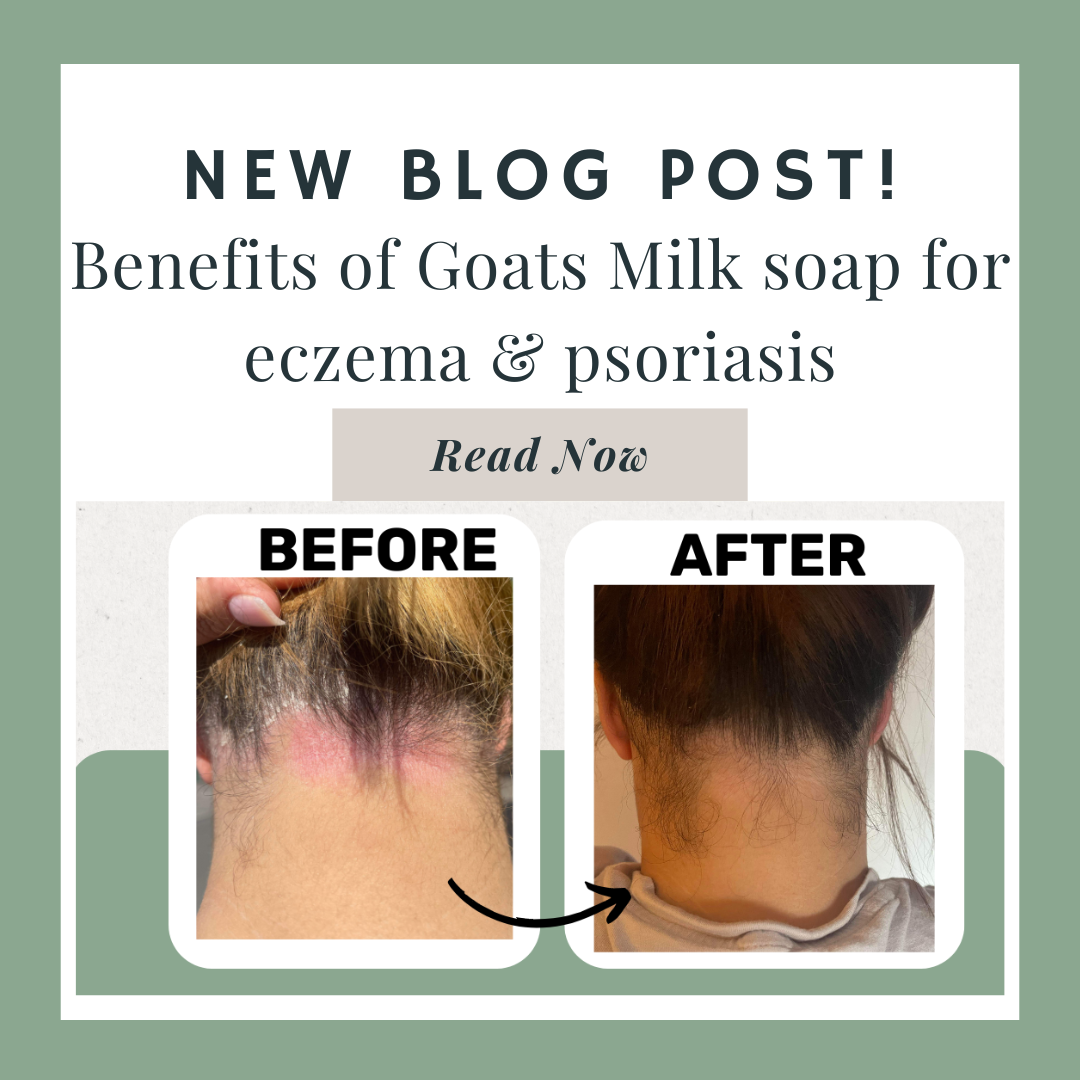 The Benefits of Goats milk soap for eczema, psoriasis or sensitive skin