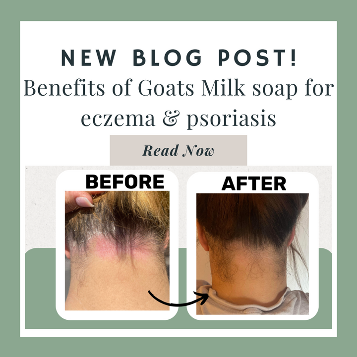 The Benefits of Goats milk soap for eczema, psoriasis or sensitive skin