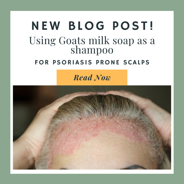 Using Goats milk soap as a shampoo for psoriasis prone scalps